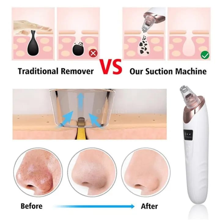 Electric Blackhead Remover Vacuum - Image 3